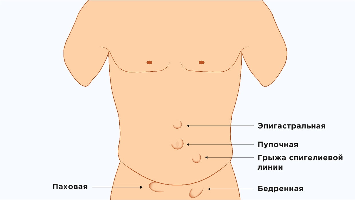 Удаление грыжи брюшной стенки бесплатно по ОМС